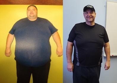 La Ronge man recovering from surgery to remove excess skin after losing 270 pounds